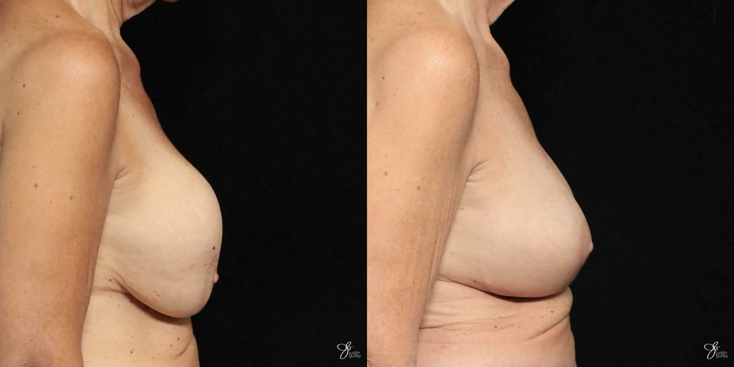 Implant Removal Replacement Before & After