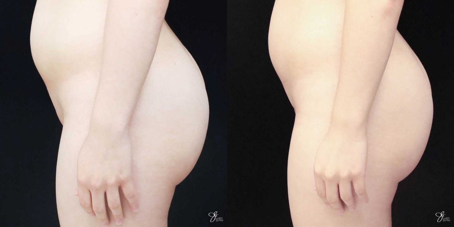 Monsplasty Fupa Reduction Before & After
