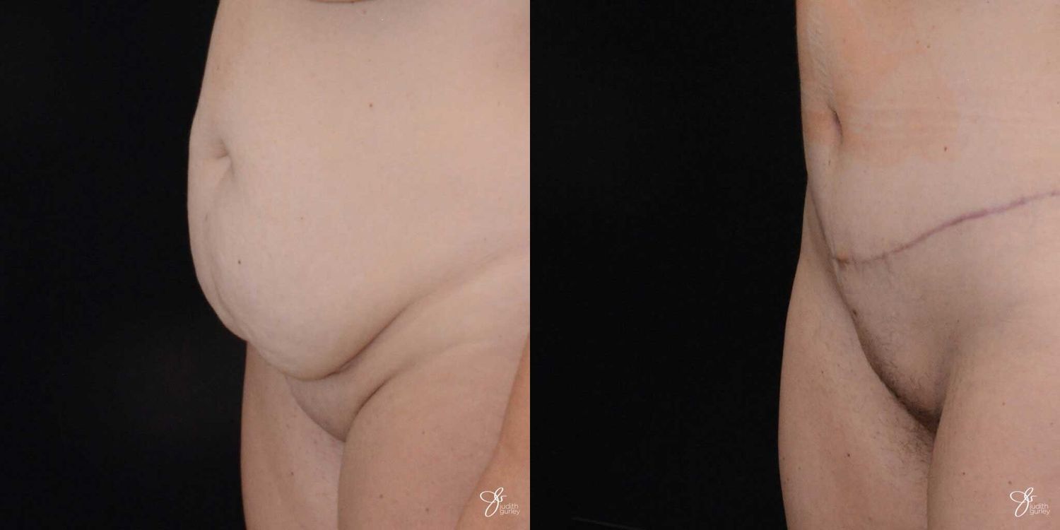 Monsplasty Fupa Reduction Before & After