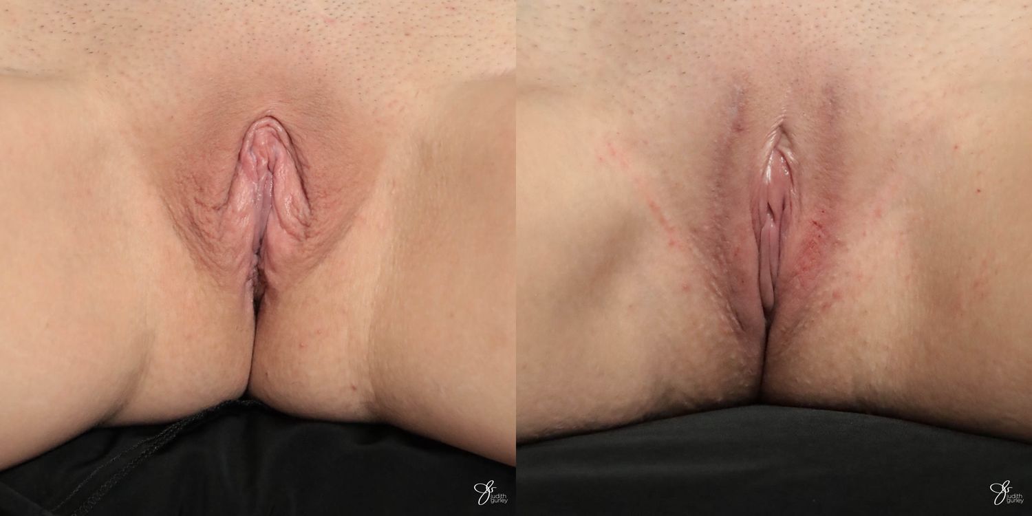 Labiaplasty Before & After