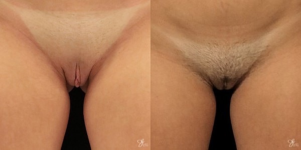 Labiaplasty Before & After