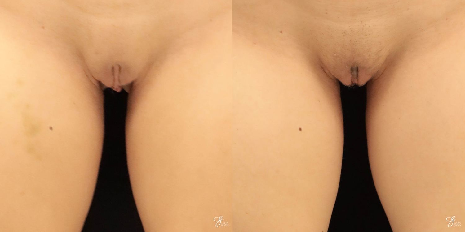 Labiaplasty Before & After