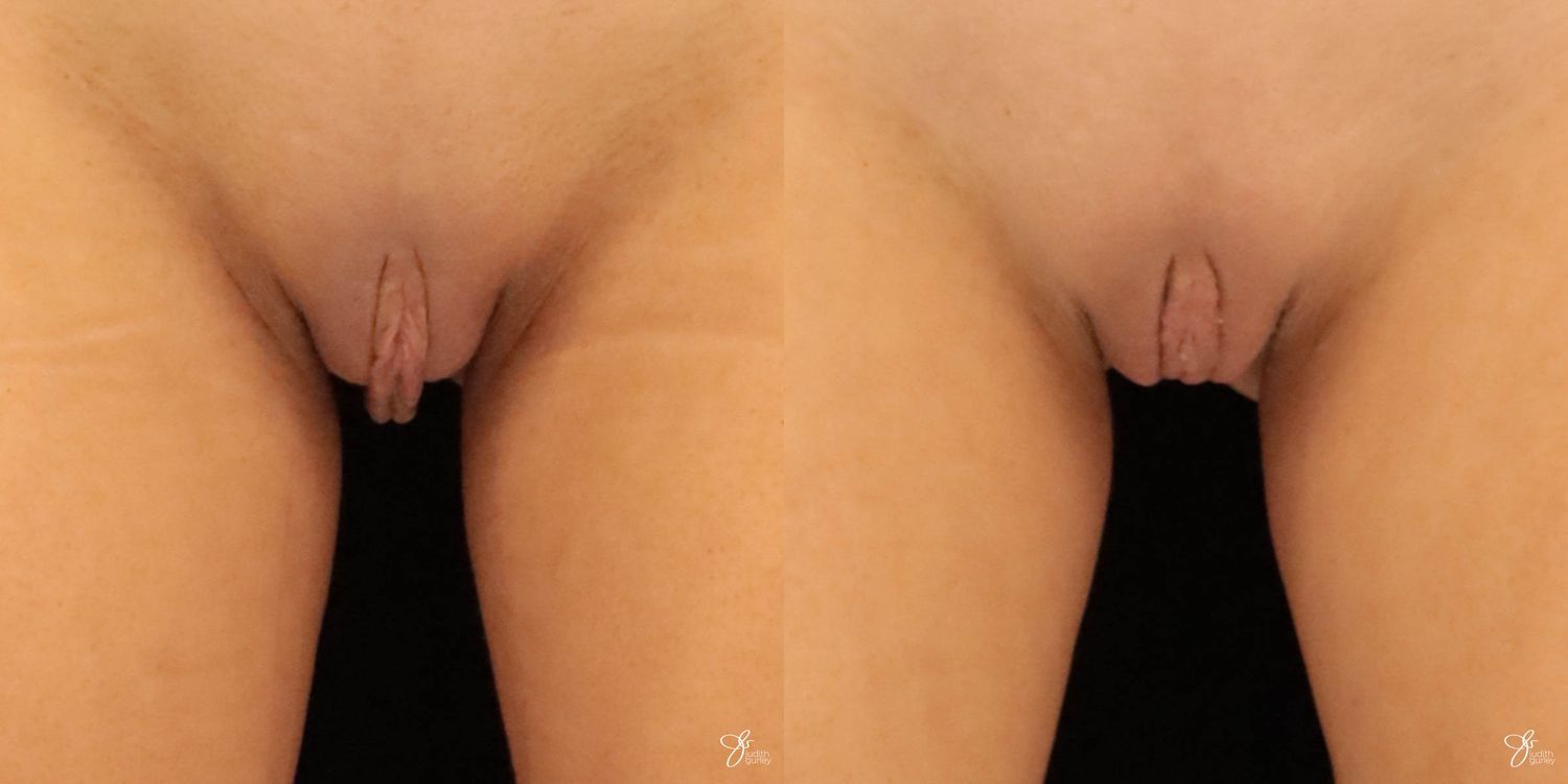 Labiaplasty Before & After
