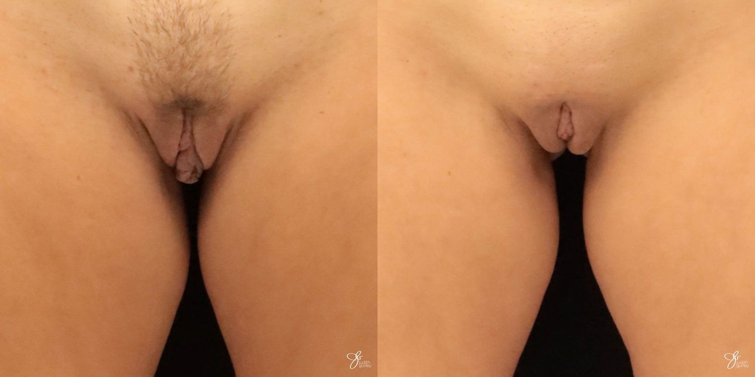 Labiaplasty Before & After