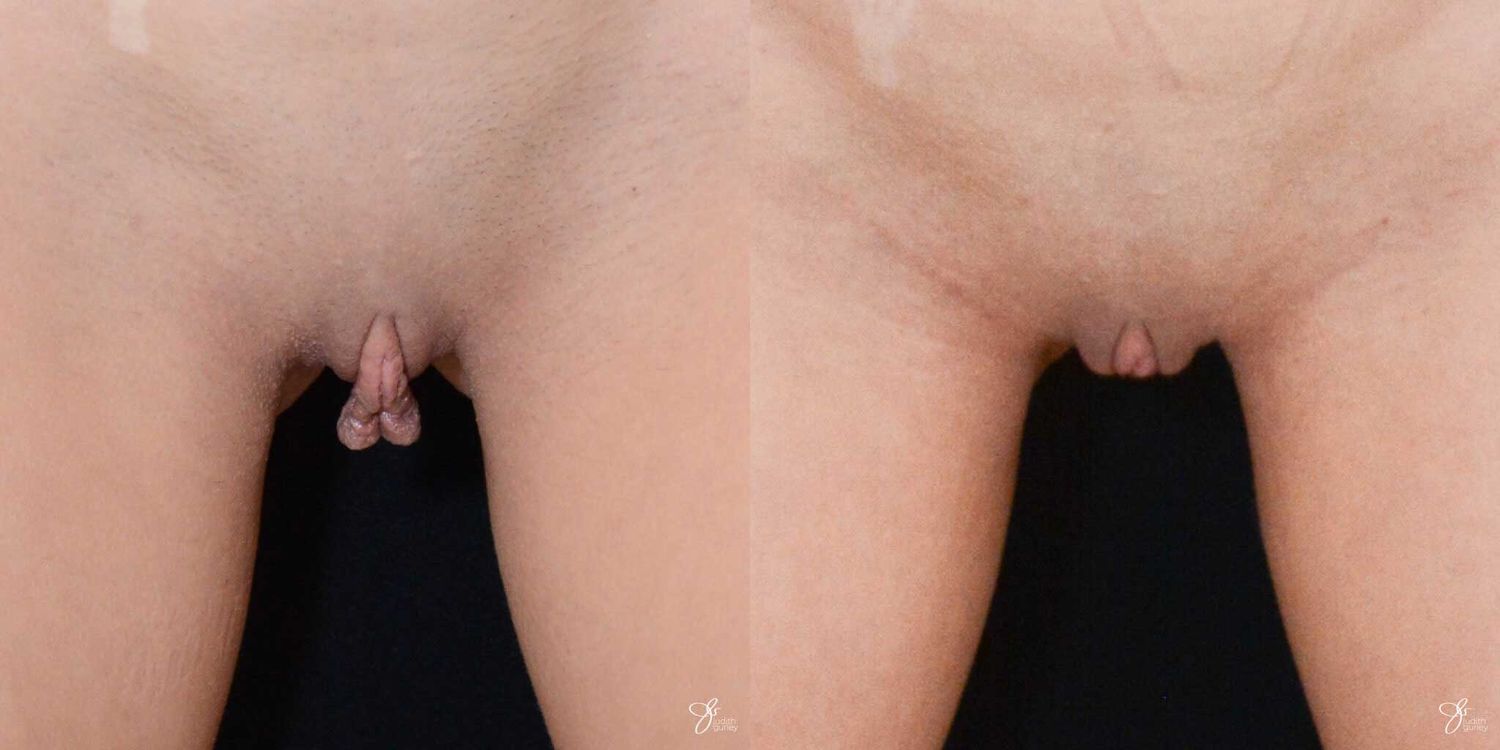 Labiaplasty Before & After