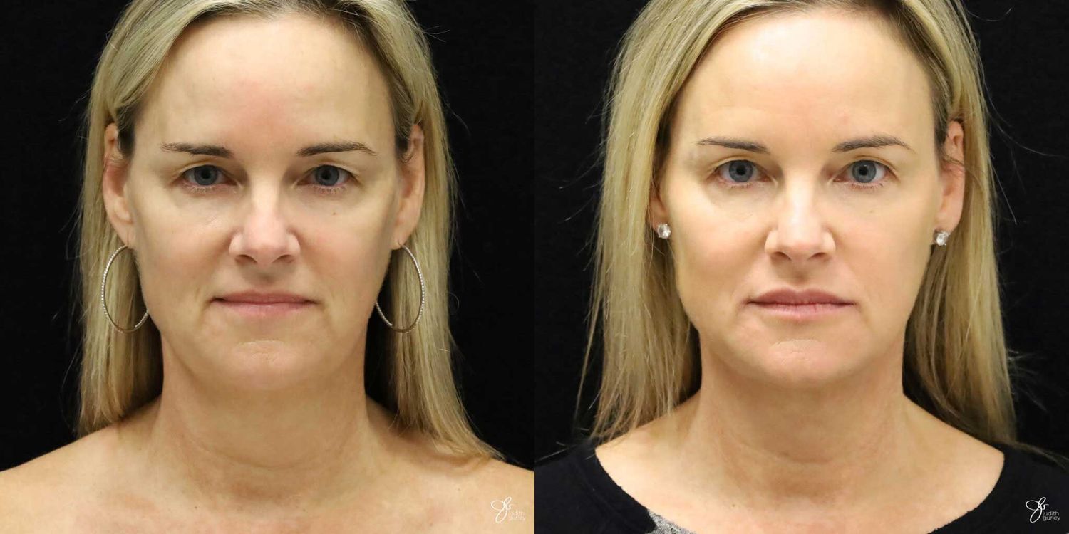 Neurotoxin Botox And Daxxify Before & After