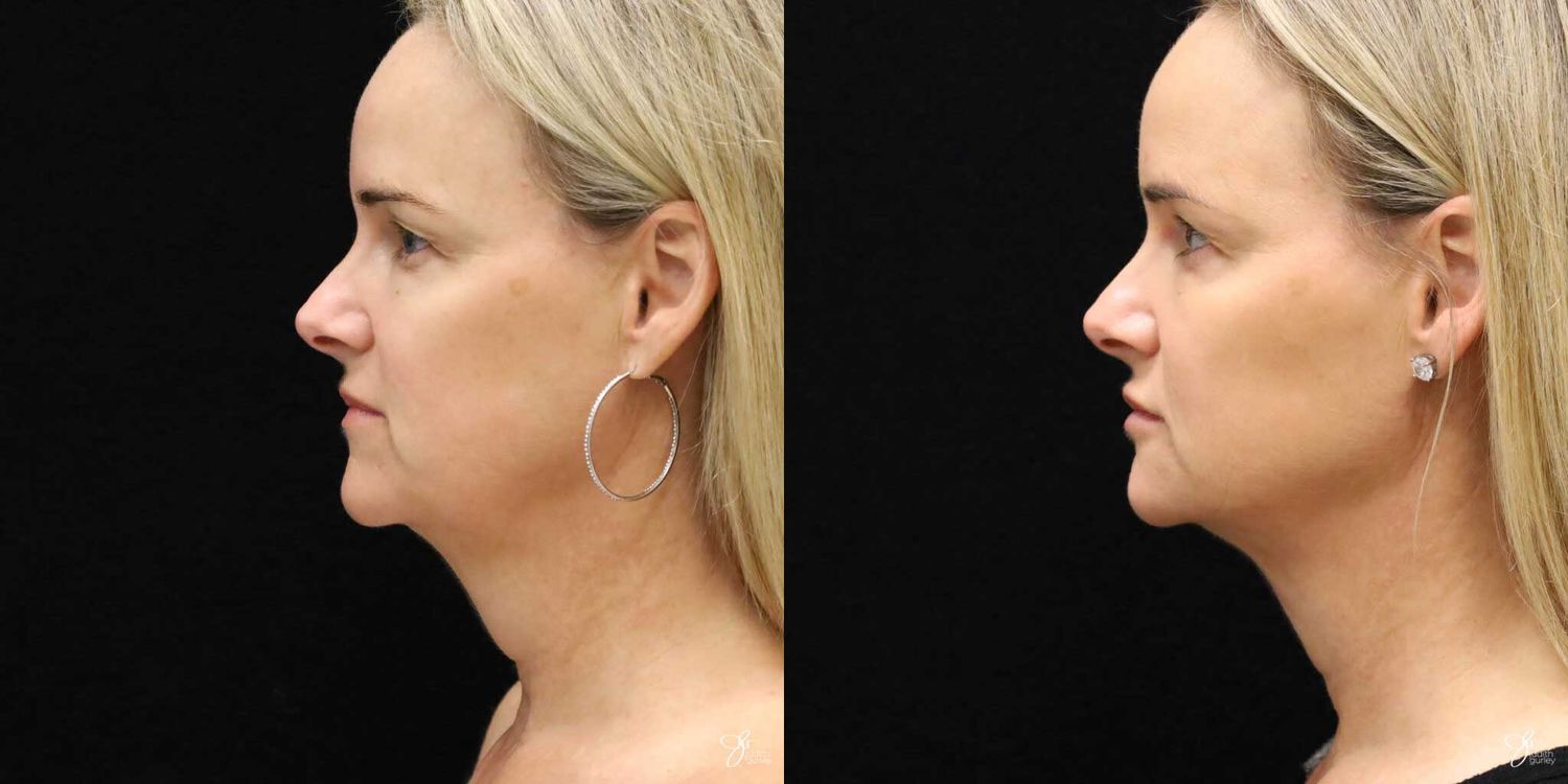 Neurotoxin Botox And Daxxify Before & After