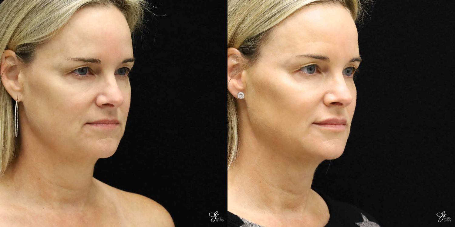 Neurotoxin Botox And Daxxify Before & After