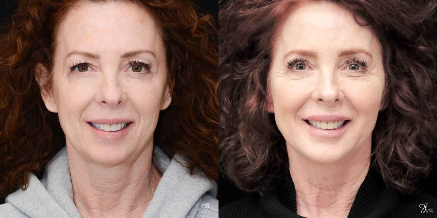 Neurotoxin Botox And Daxxify Before & After