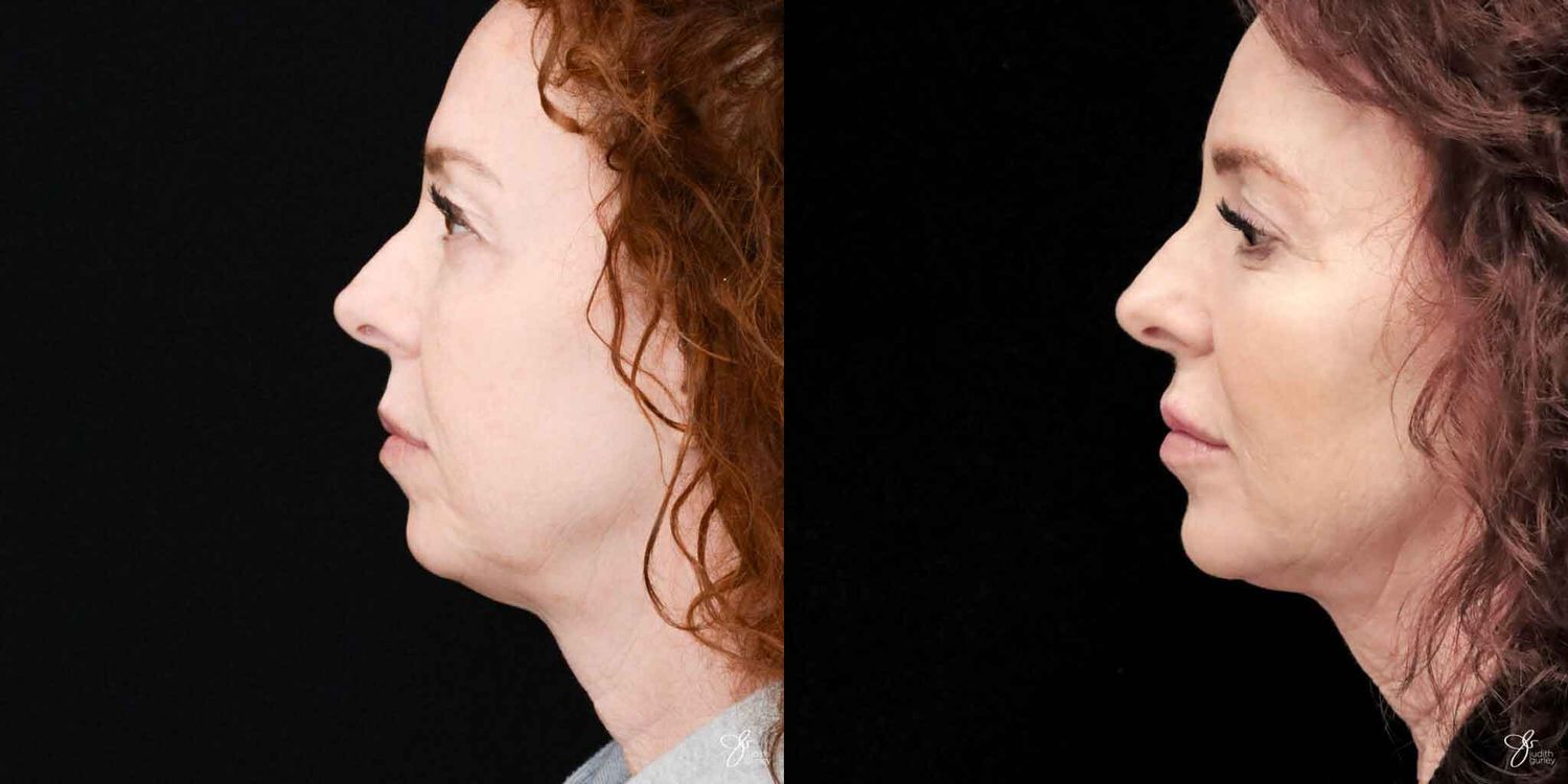 Neurotoxin Botox And Daxxify Before & After