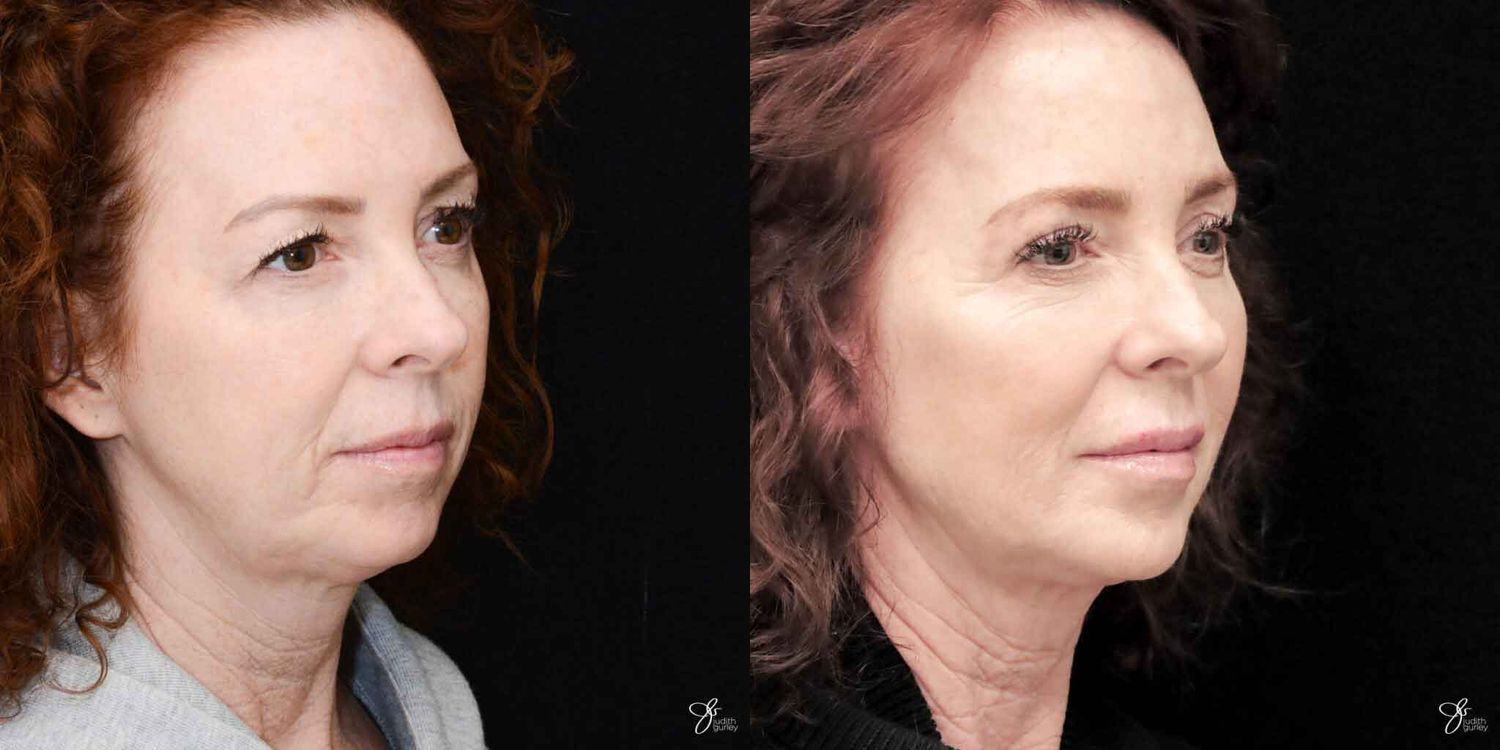 Neurotoxin Botox And Daxxify Before & After
