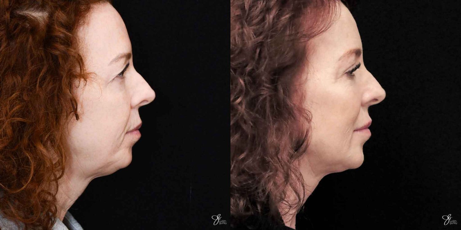 Neurotoxin Botox And Daxxify Before & After