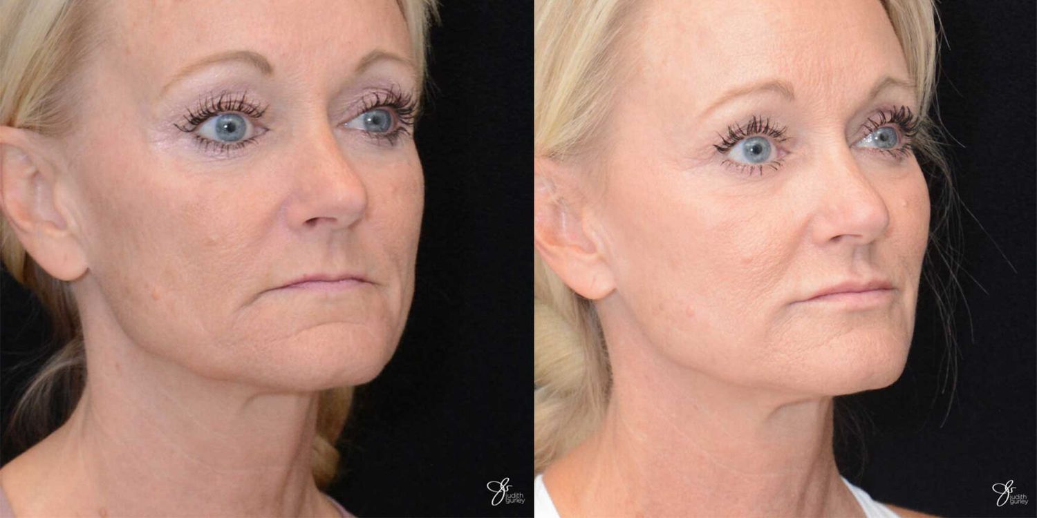 Neurotoxin Botox And Daxxify Before & After