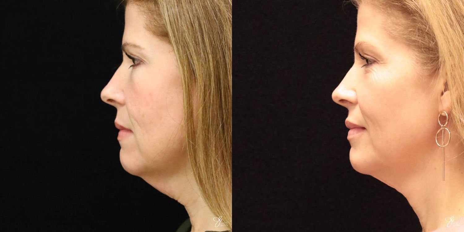 Neurotoxin Botox And Daxxify Before & After