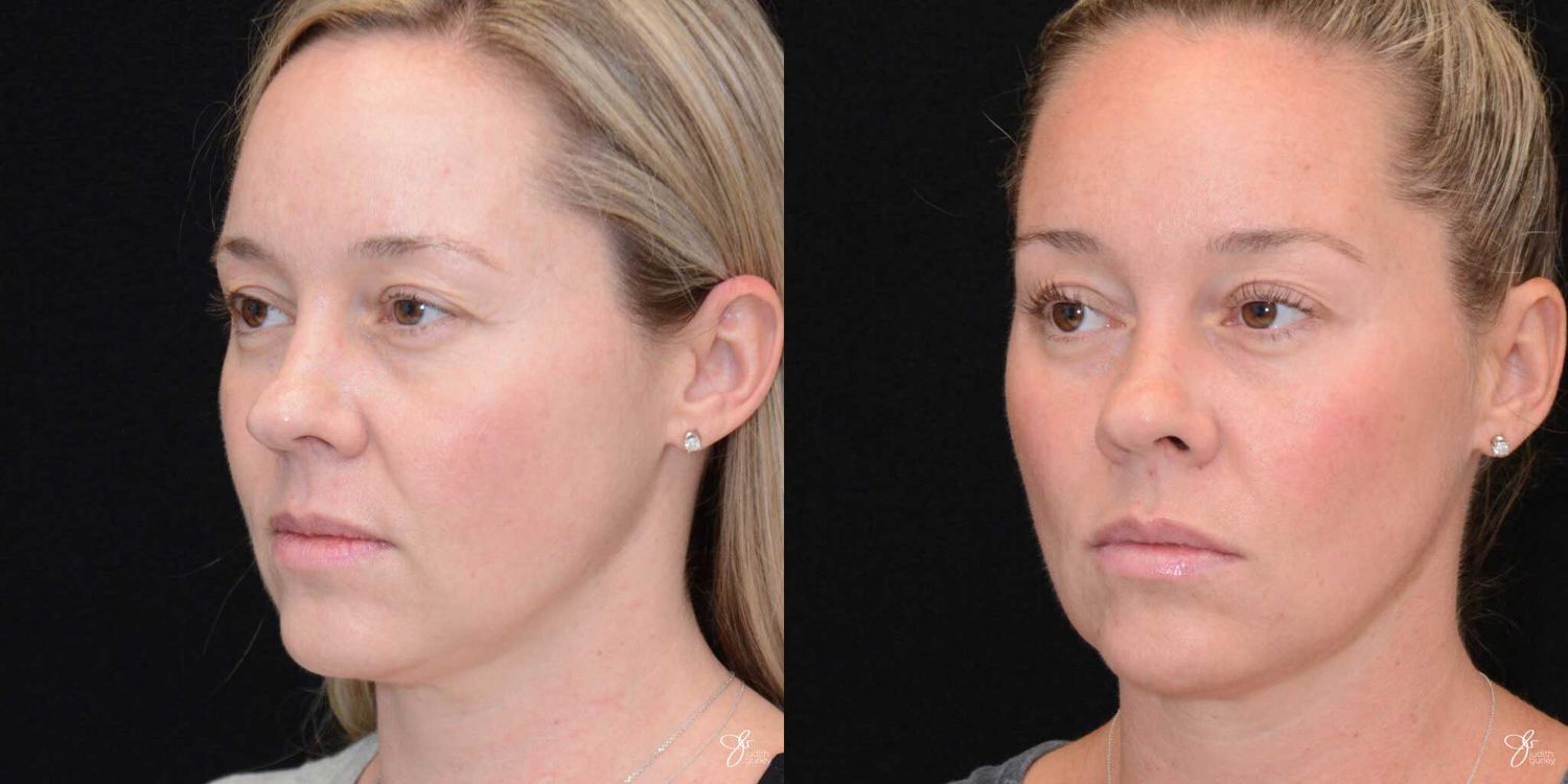 Neurotoxin Botox And Daxxify Before & After