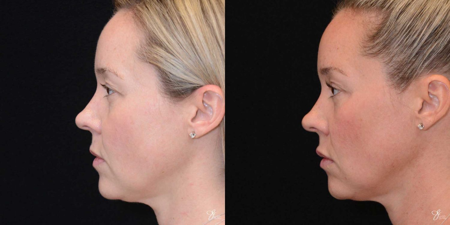 Neurotoxin Botox And Daxxify Before & After