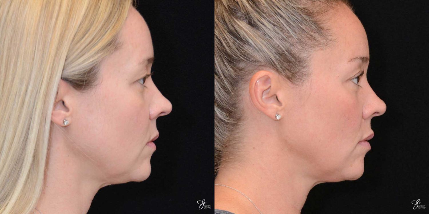 Neurotoxin Botox And Daxxify Before & After