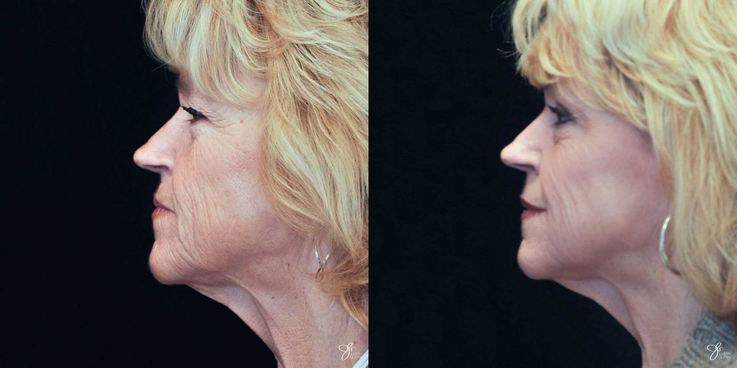 Neurotoxin Botox And Daxxify Before & After
