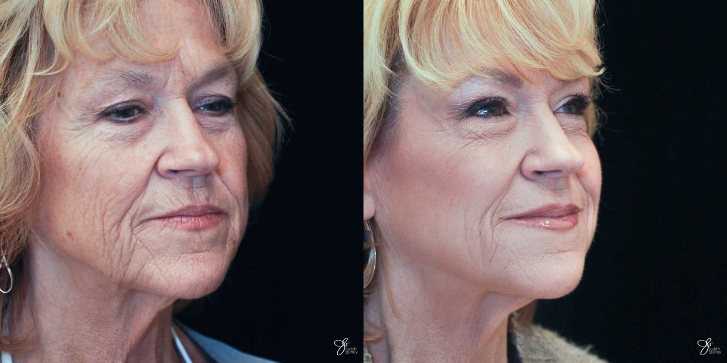 Neurotoxin Botox And Daxxify Before & After