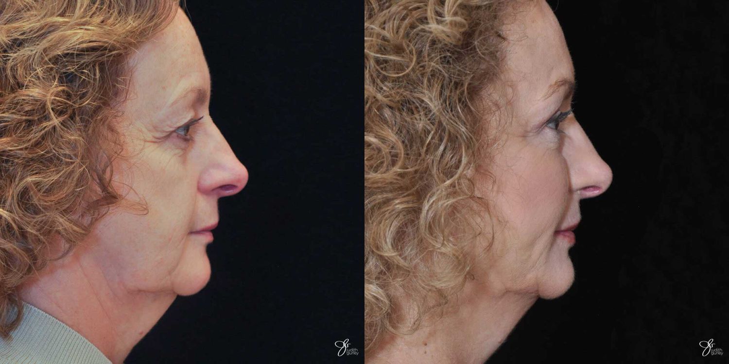 Neurotoxin Botox And Daxxify Before & After
