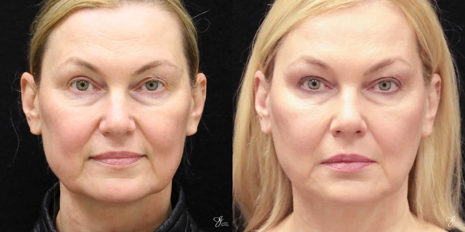 Neurotoxin Botox And Daxxify Before & After