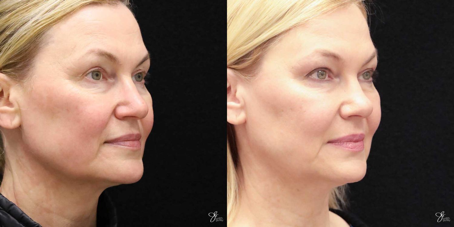 Neurotoxin Botox And Daxxify Before & After