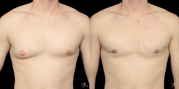 Gynecomastia Correction Before & After