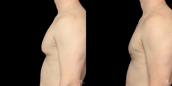 Gynecomastia Correction Before & After
