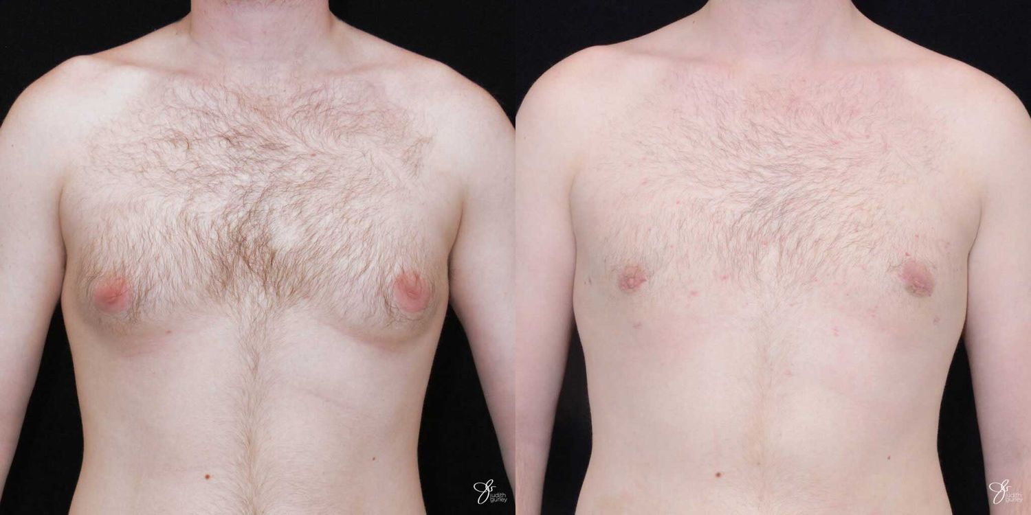Gynecomastia Correction Before & After