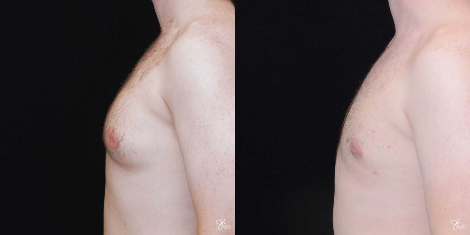 Gynecomastia Correction Before & After
