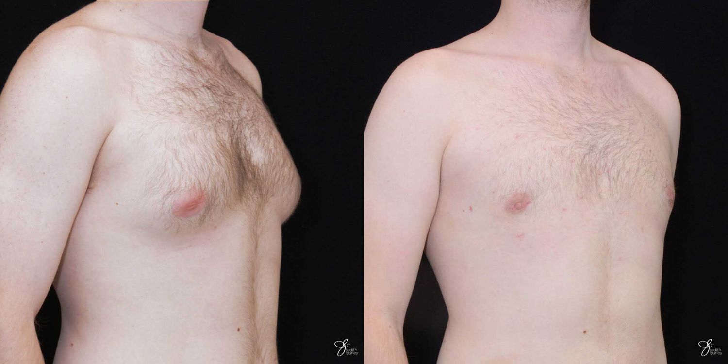 Gynecomastia Correction Before & After