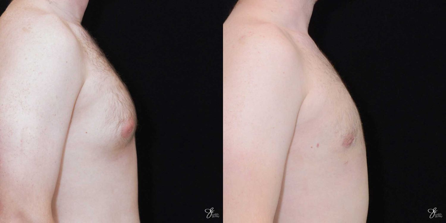 Gynecomastia Correction Before & After