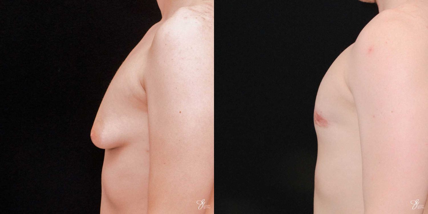 Gynecomastia Correction Before & After