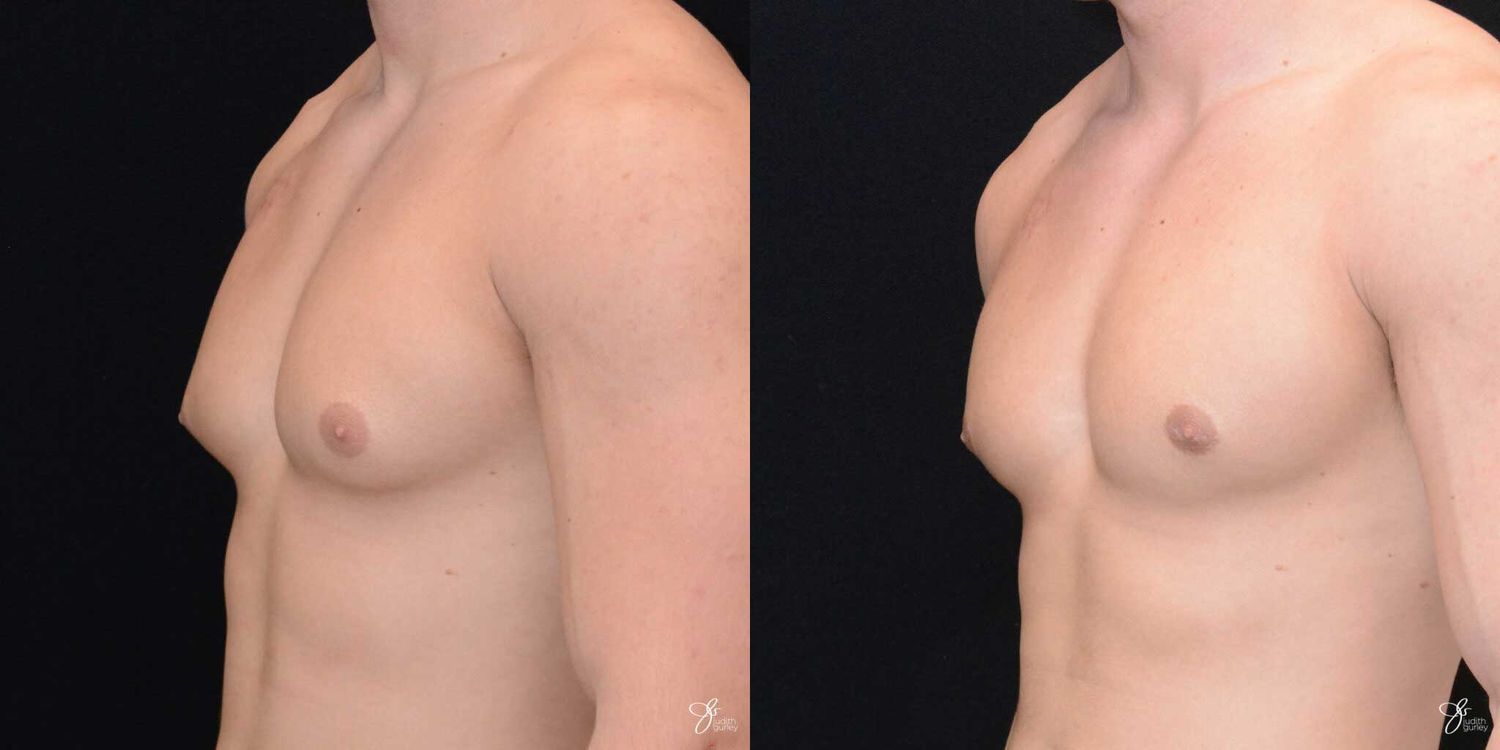 Gynecomastia Correction Before & After