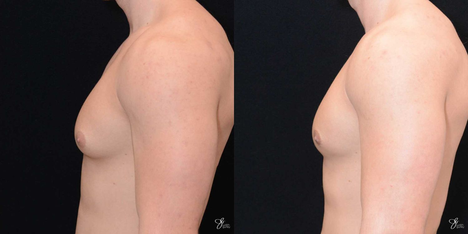 Gynecomastia Correction Before & After