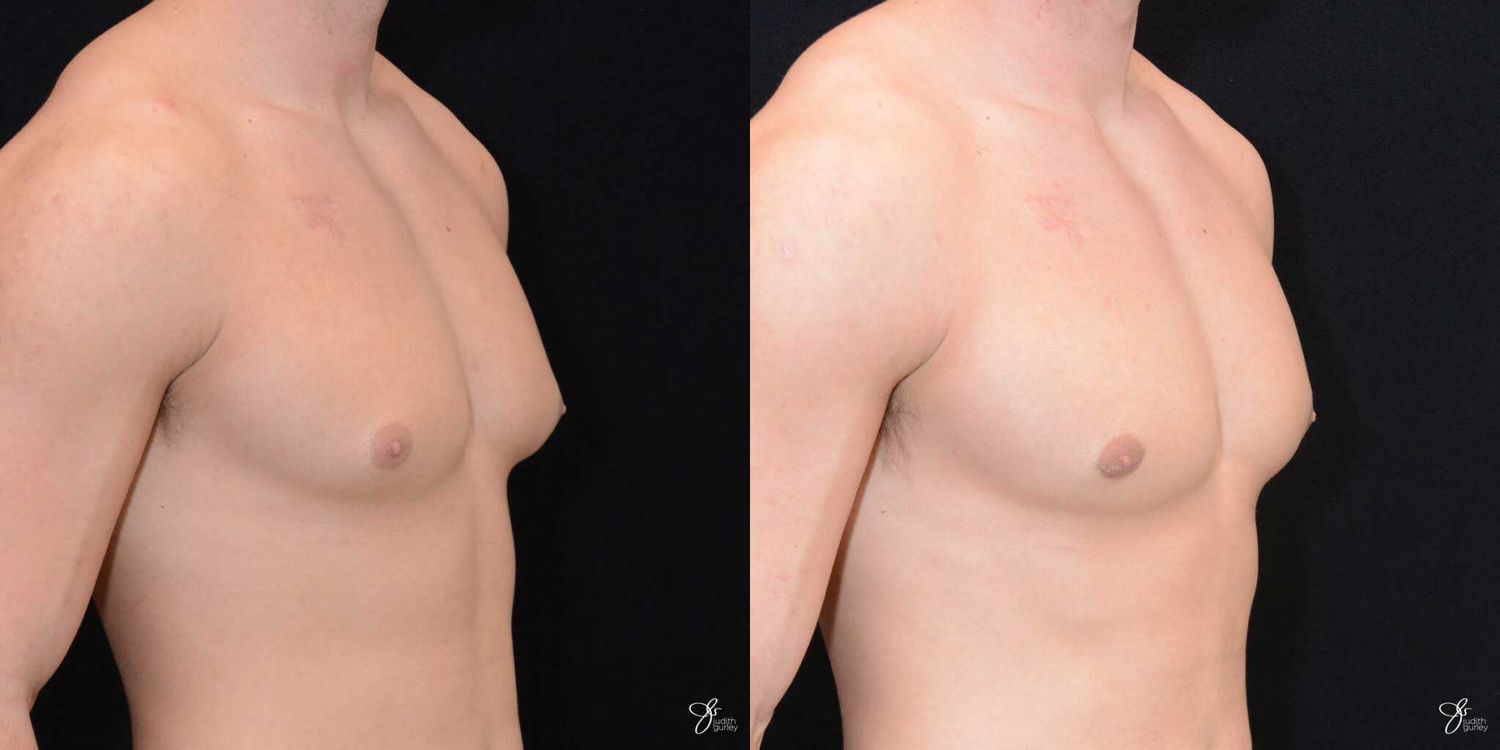 Gynecomastia Correction Before & After