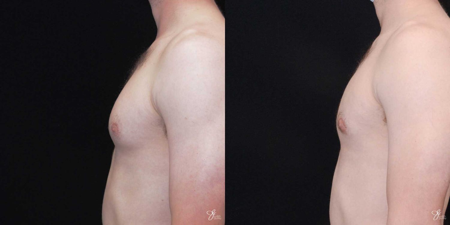 Gynecomastia Correction Before & After