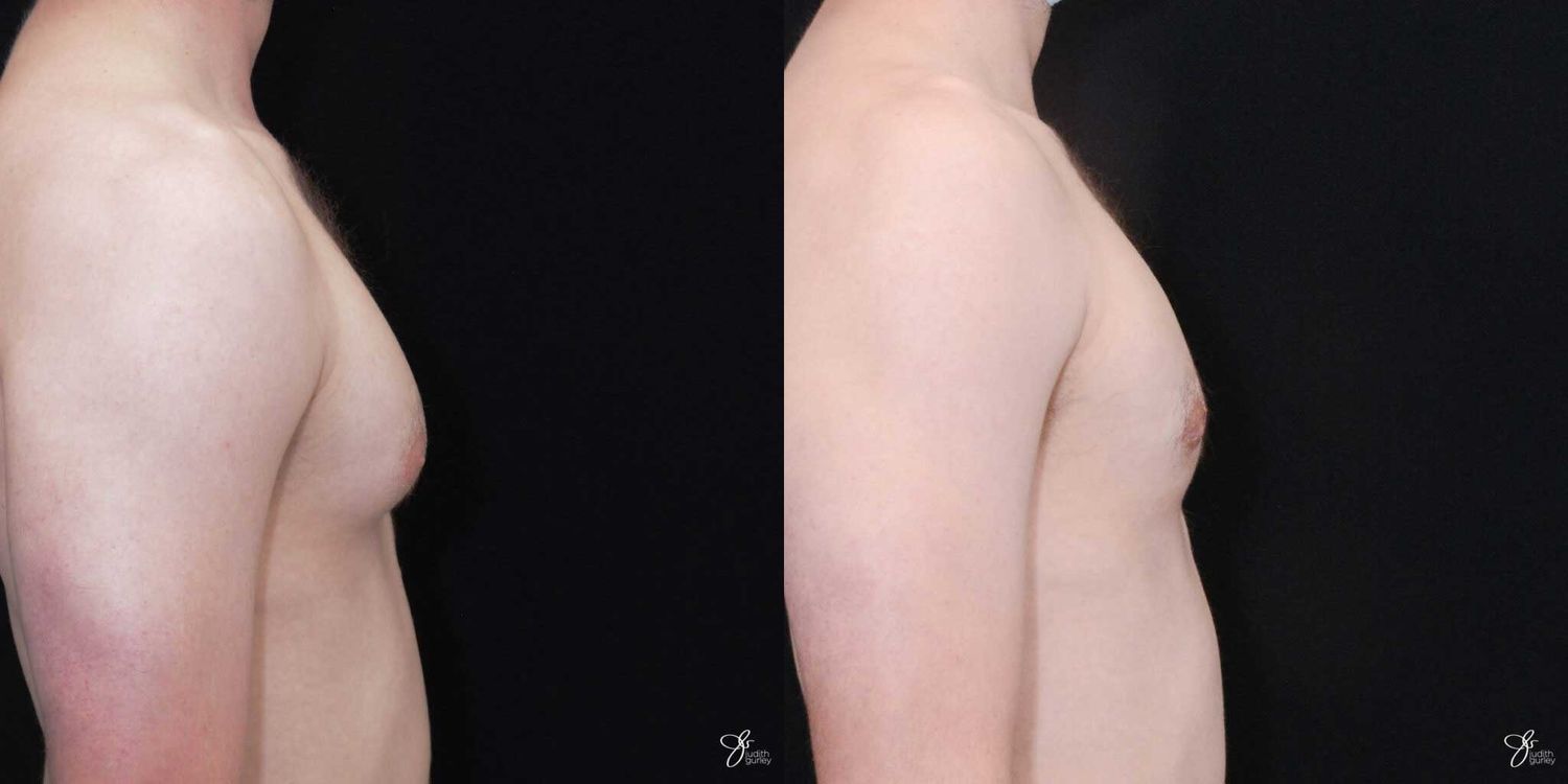 Gynecomastia Correction Before & After