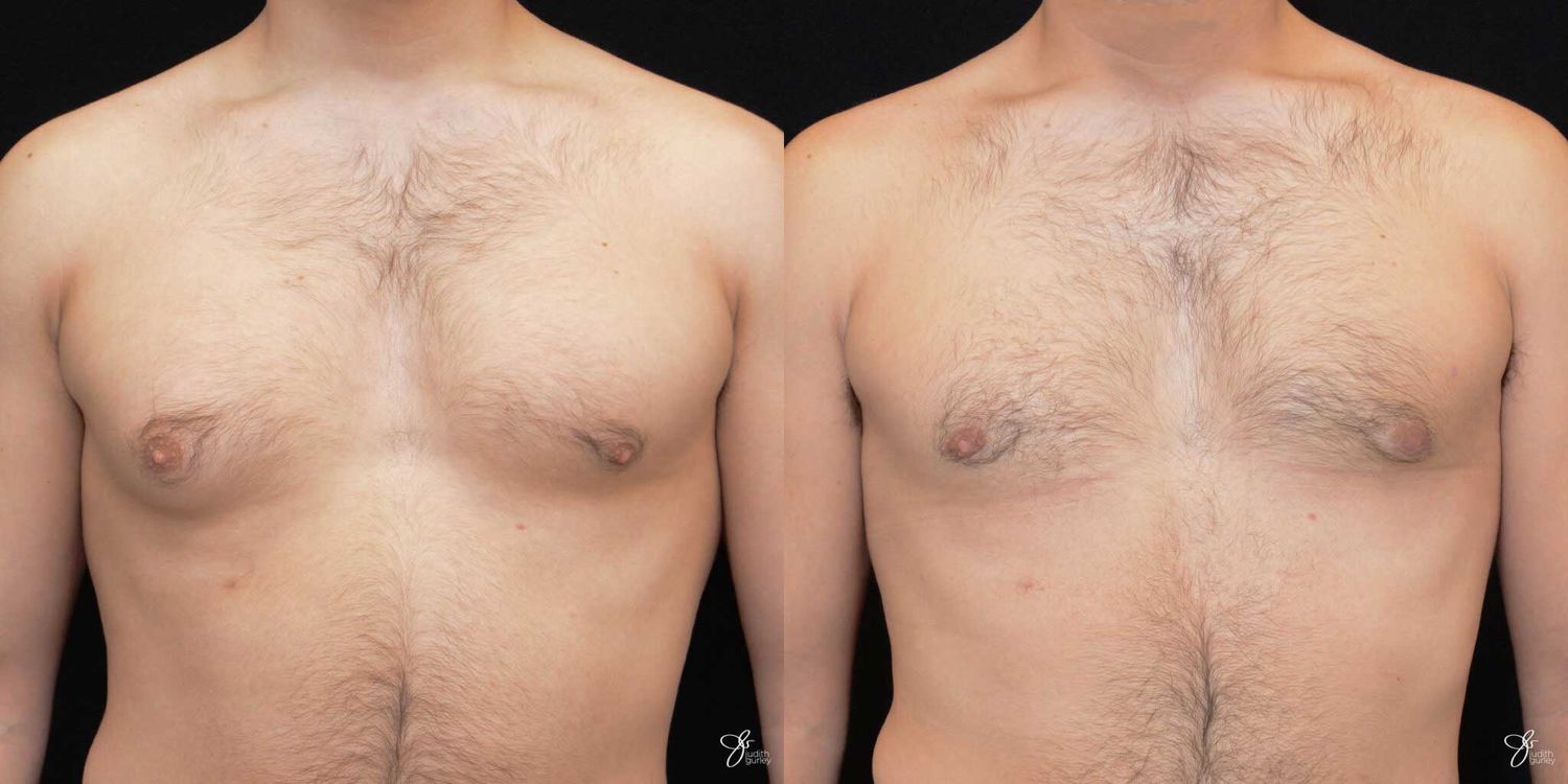 Gynecomastia Correction Before & After