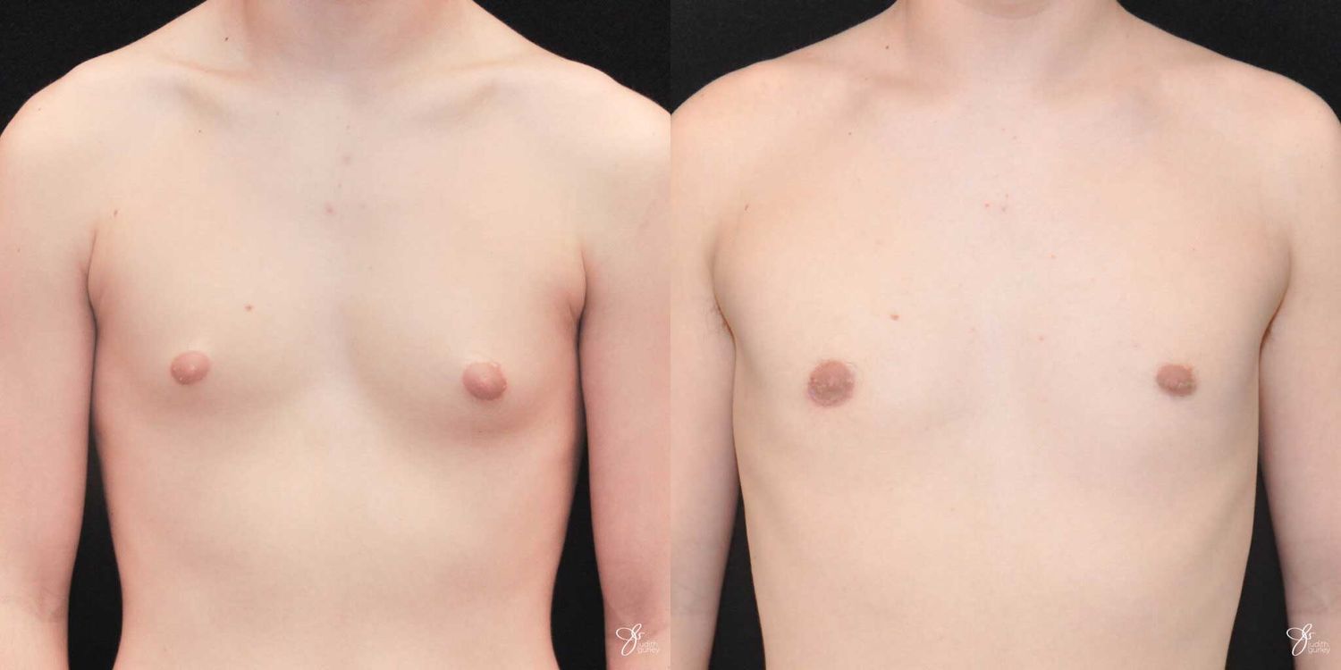 Gynecomastia Correction Before & After