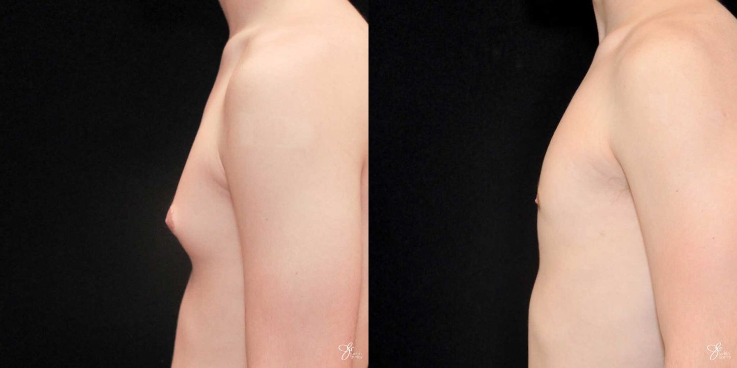 Gynecomastia Correction Before & After