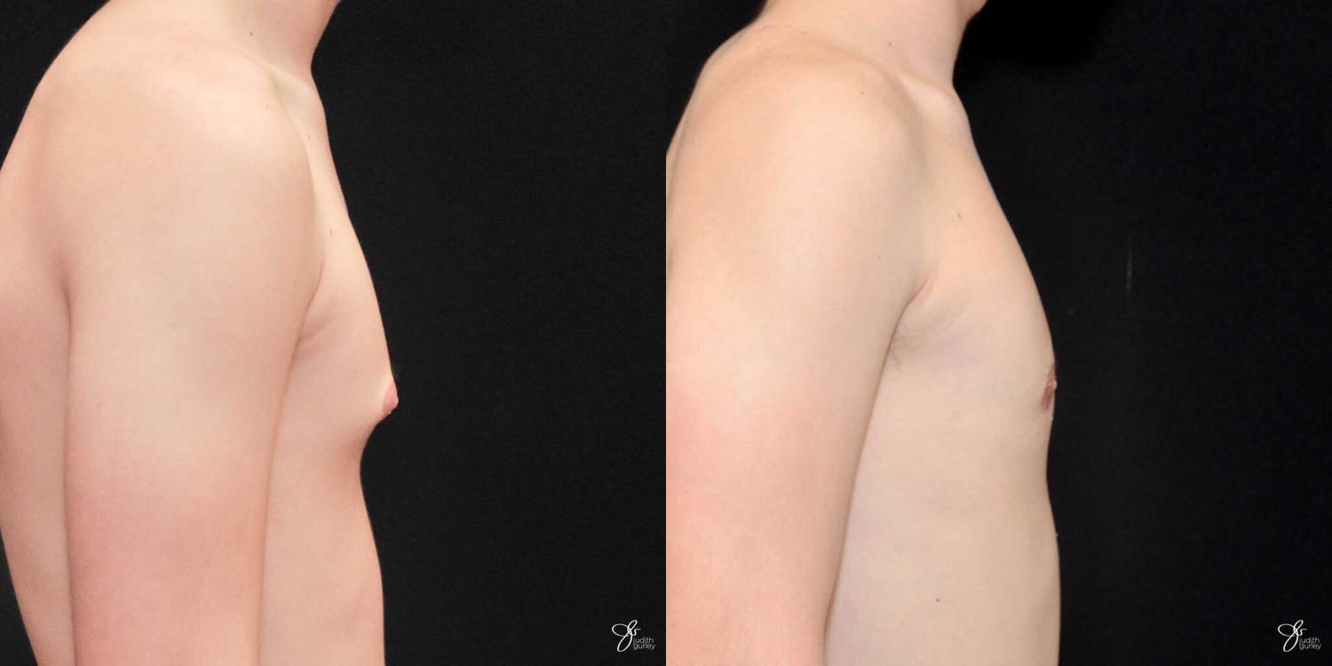 Gynecomastia Correction Before & After