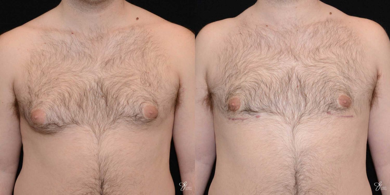 Gynecomastia Correction Before & After