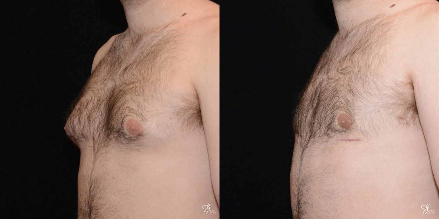 Gynecomastia Correction Before & After