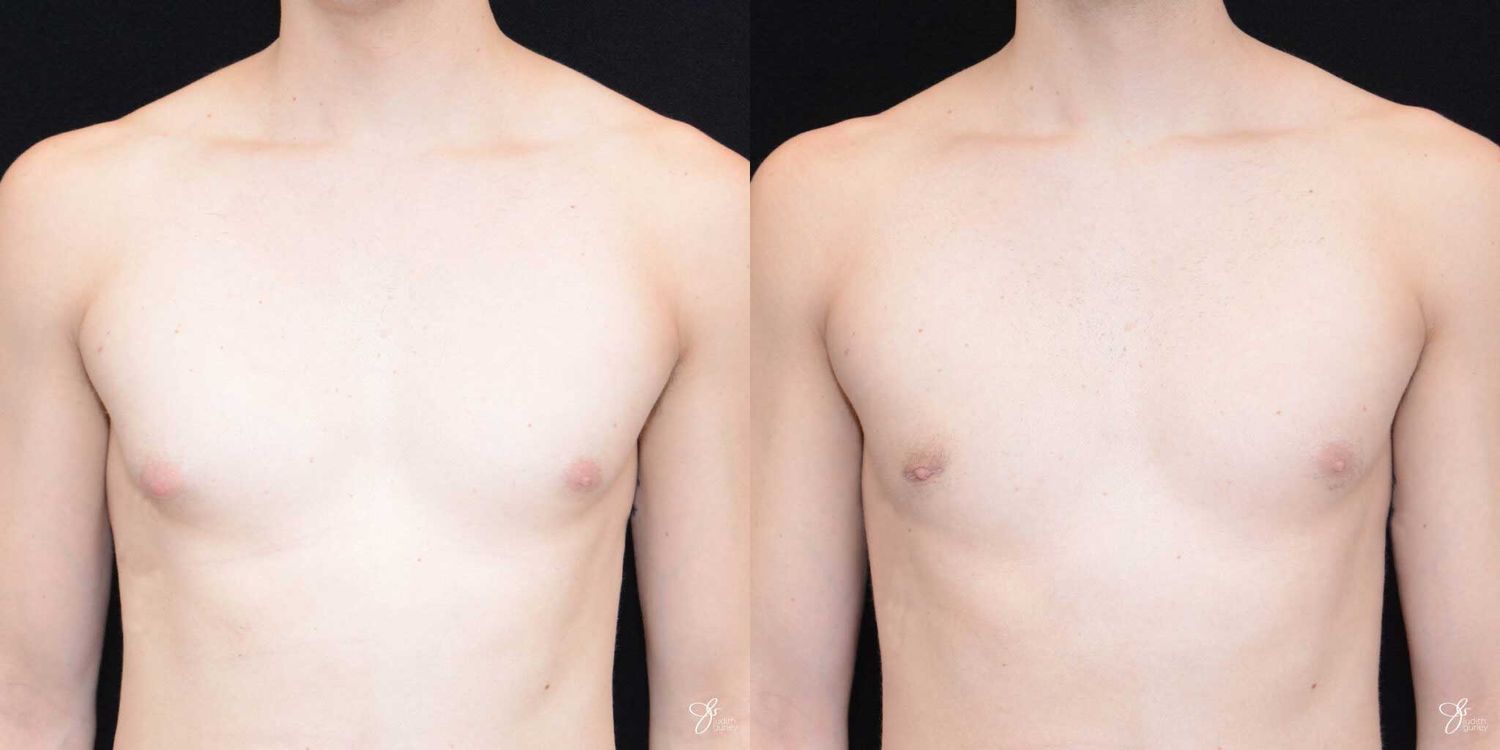 Gynecomastia Correction Before & After