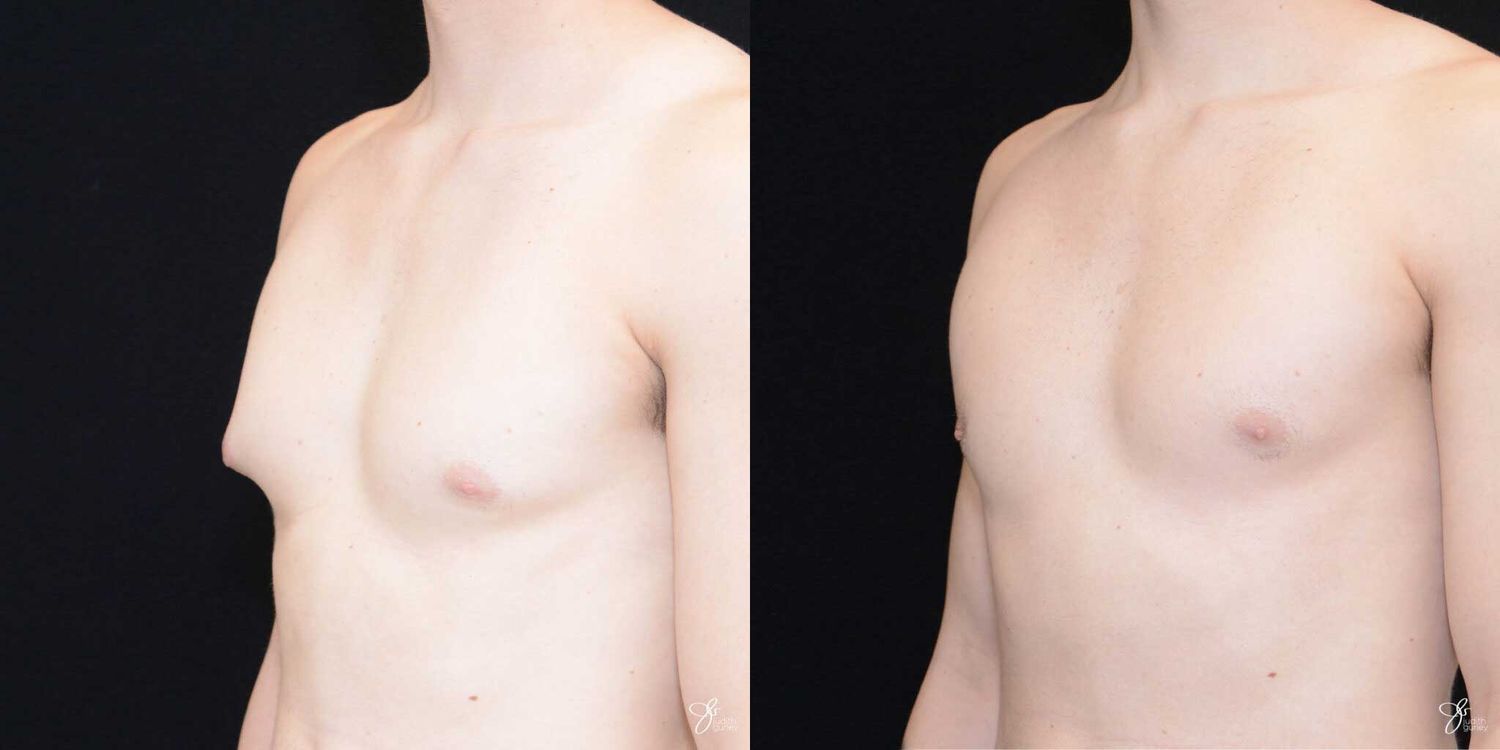 Gynecomastia Correction Before & After