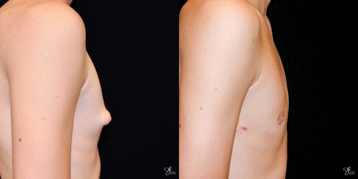 Gynecomastia Correction Before & After