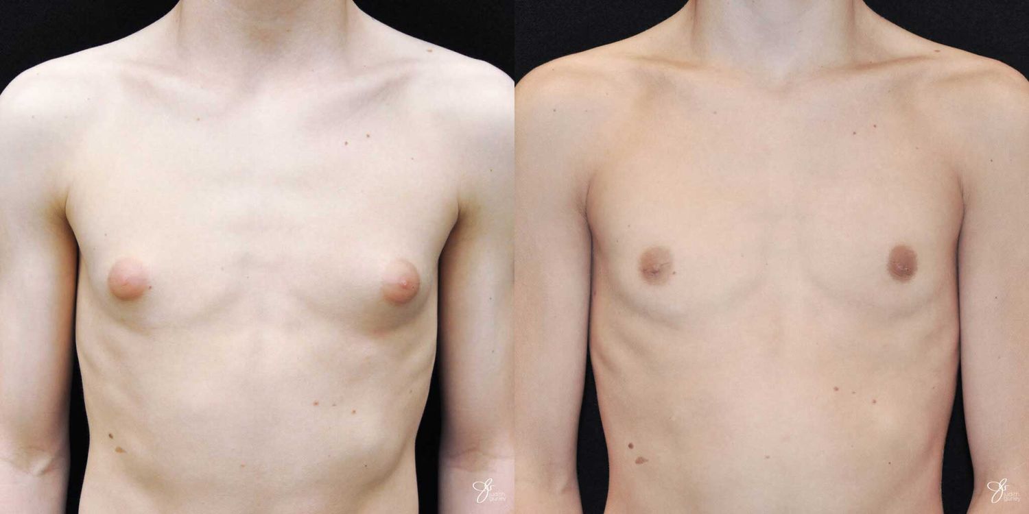 Gynecomastia Correction Before & After
