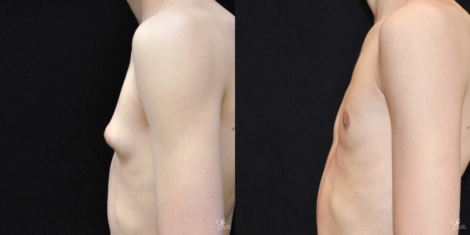 Gynecomastia Correction Before & After