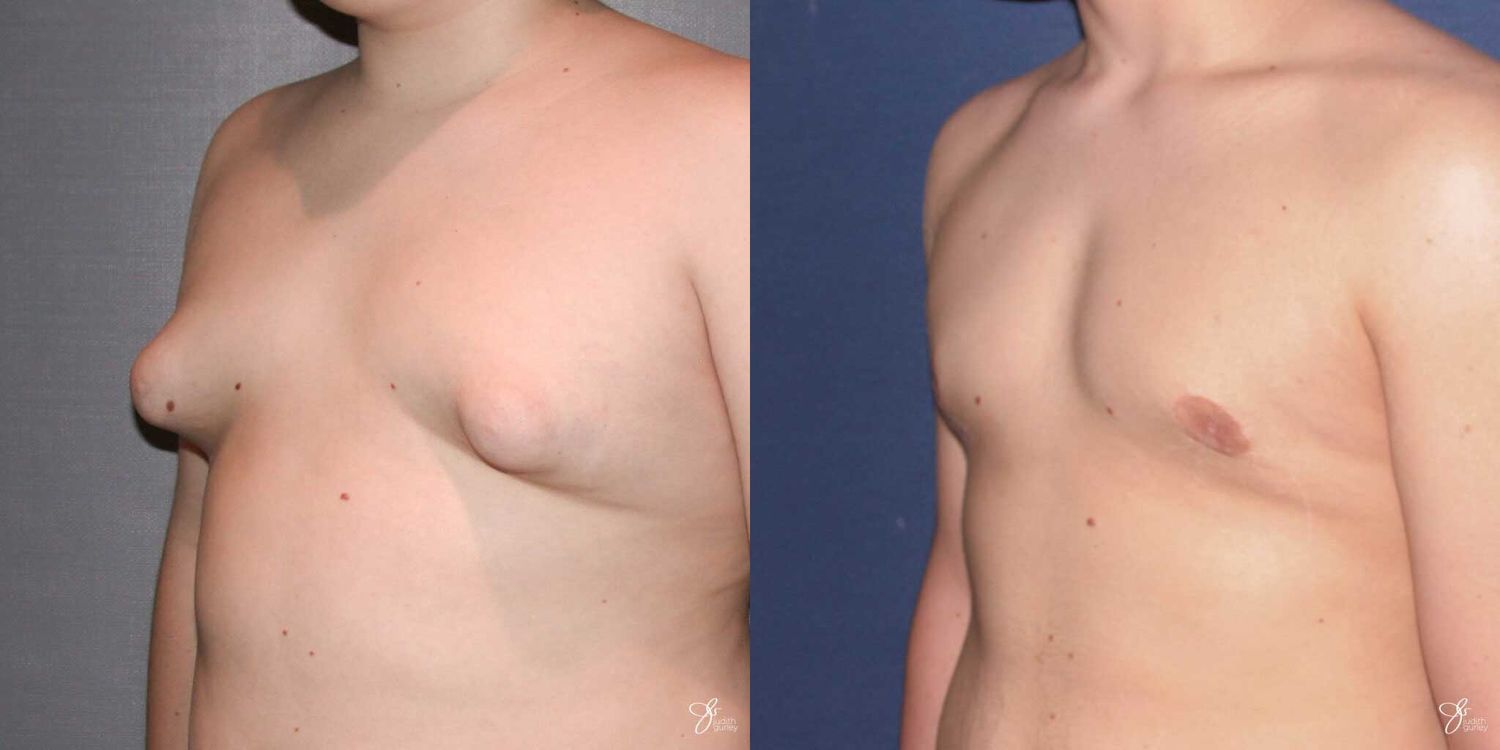 Gynecomastia Correction Before & After